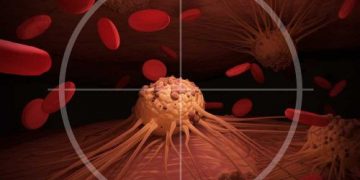 Pancreatic Neuroendocrine Cancer Information - Oren Zarif