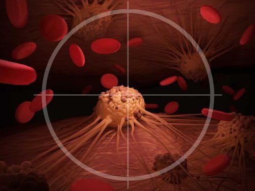 Pancreatic Neuroendocrine Cancer Information - Oren Zarif