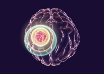Stroke Symptoms - Oren Zarif