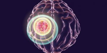 Stroke Symptoms - Oren Zarif