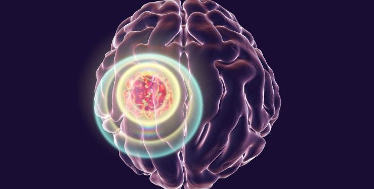 Stroke Symptoms - Oren Zarif