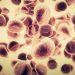 Common Types of Cancers That Older Adults Afford to Know About - Oren Zarif